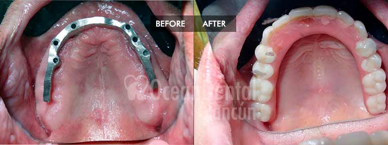 before and after of treatment fixed hybdrid dentures in mexico