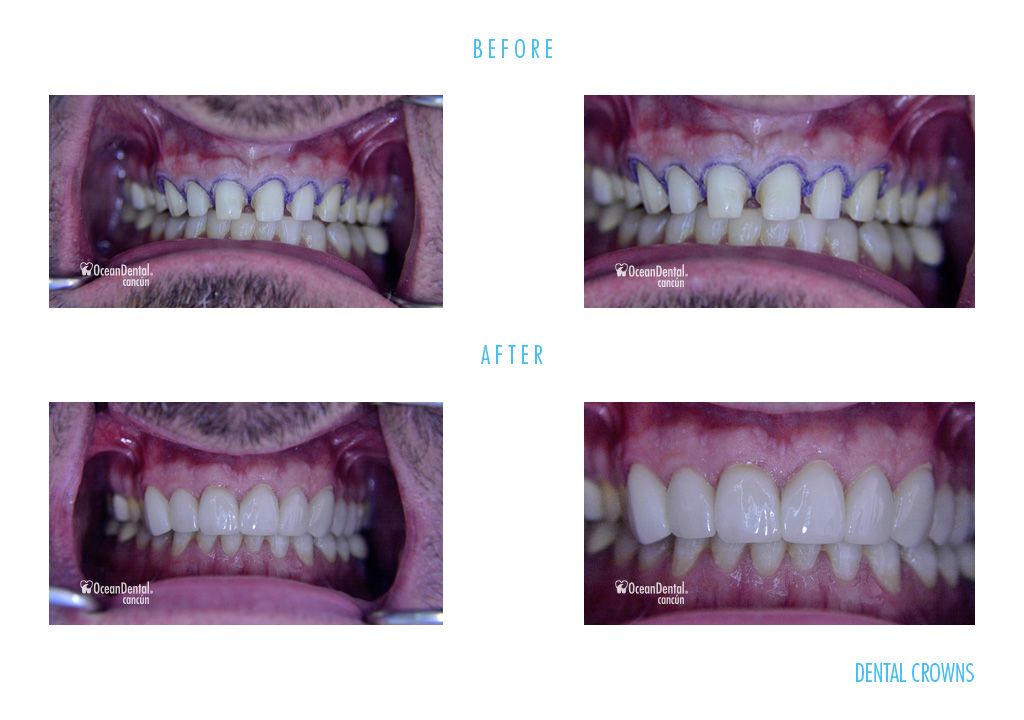 before and after dental crown