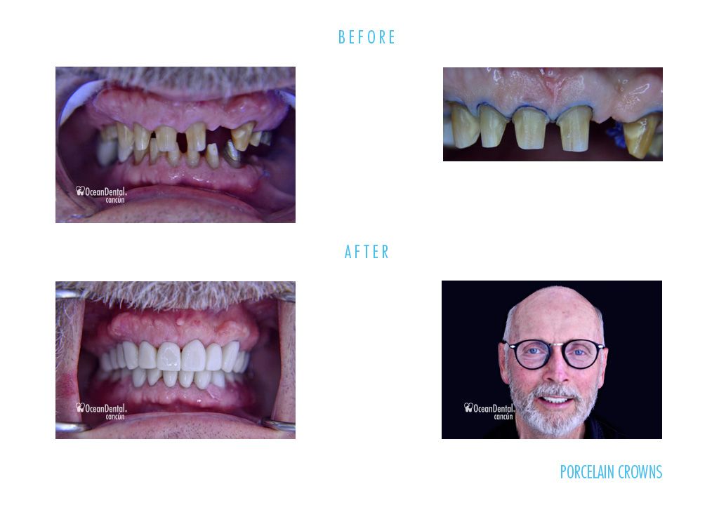 before and after porcelain crowns