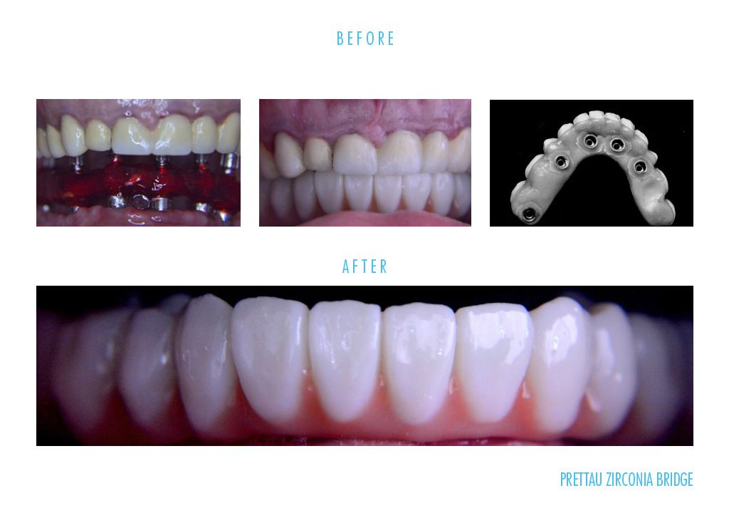 before and after dental prettau zirconia bridge