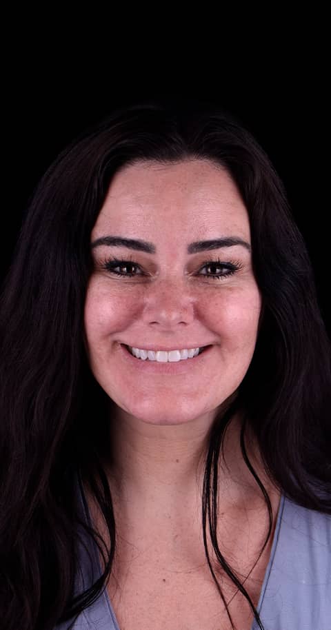 veneers in mexico before and after