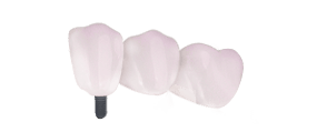 3 unit dental bridges in cancun