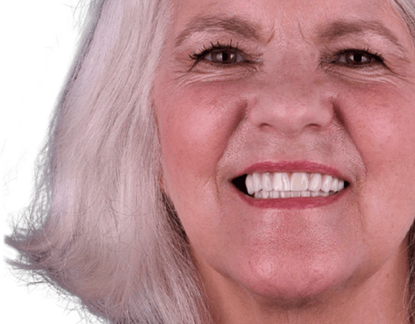 all on 4 dental implants restoration in mexico