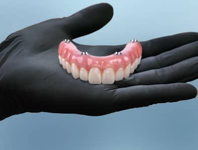 all on 4 implants in cancun mexico