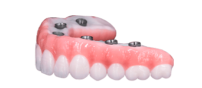 all on 6 dental implants