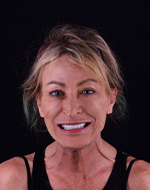 all on 6 teeth restoration in mexico