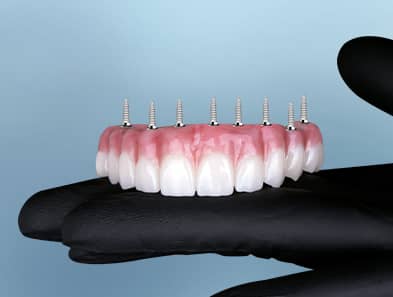 all on 8 dental implants