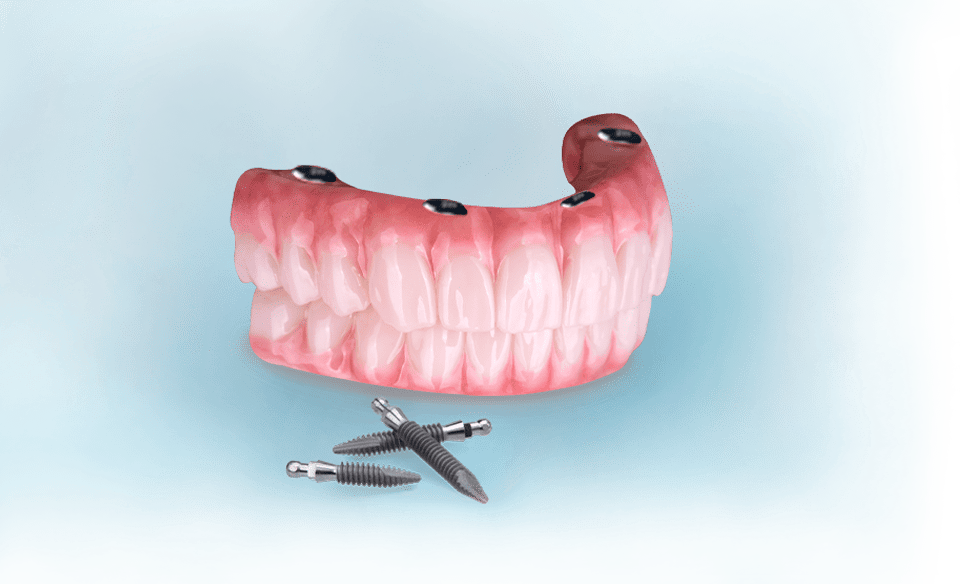 all on four implants in mexico