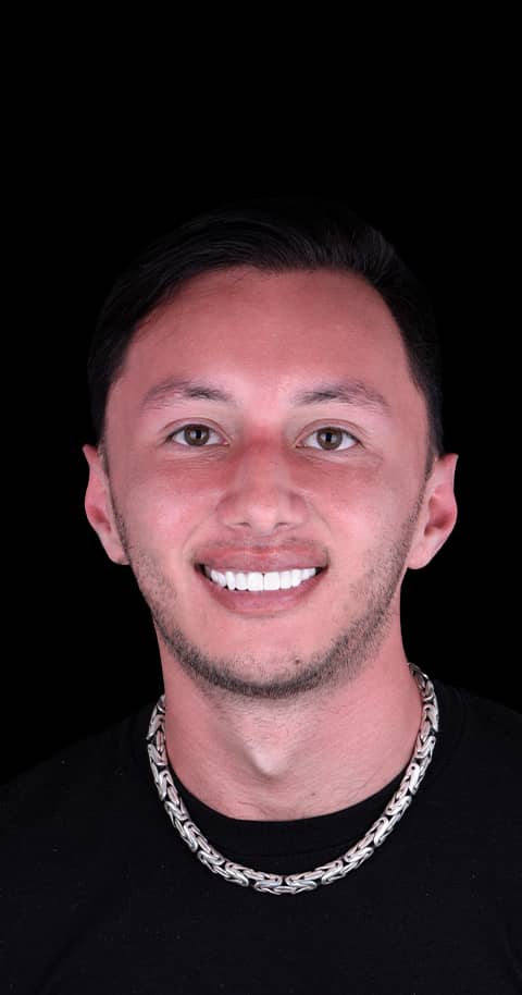 braces in mexico before and after