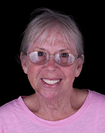 clip on dentures reviews in mexico