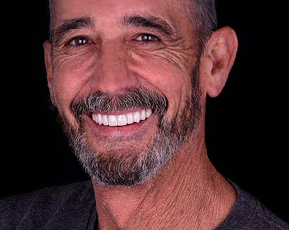 complete mouth restoration in mexico