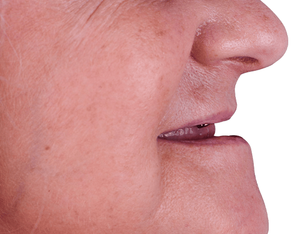 completely edentulous patient