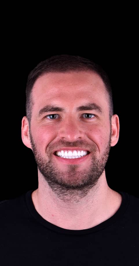 custom fit dental bridges in mexico