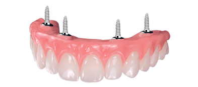 full mouth all on 4 dental implants