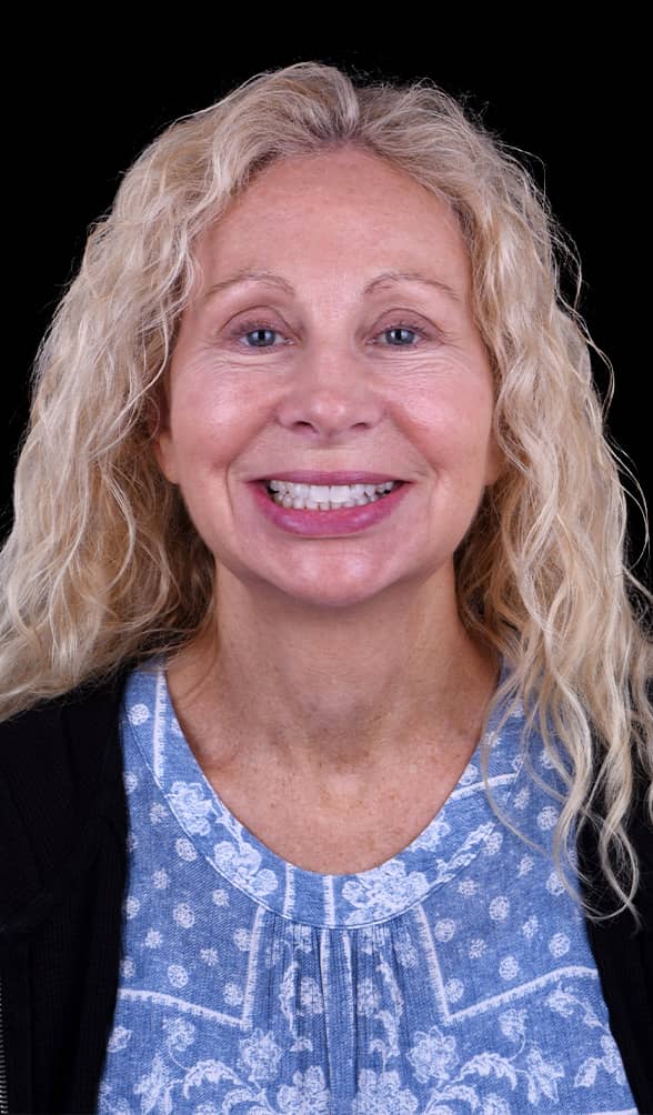 full mouth implant reconstruction