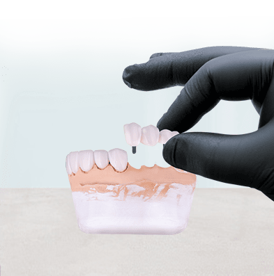 implant supported dental bridges in cancun
