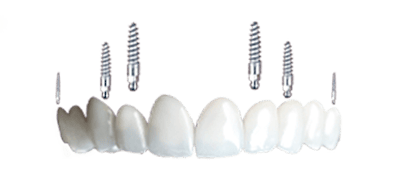 implant supported dental bridges in mexico