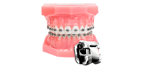 regular metal braces in mexico