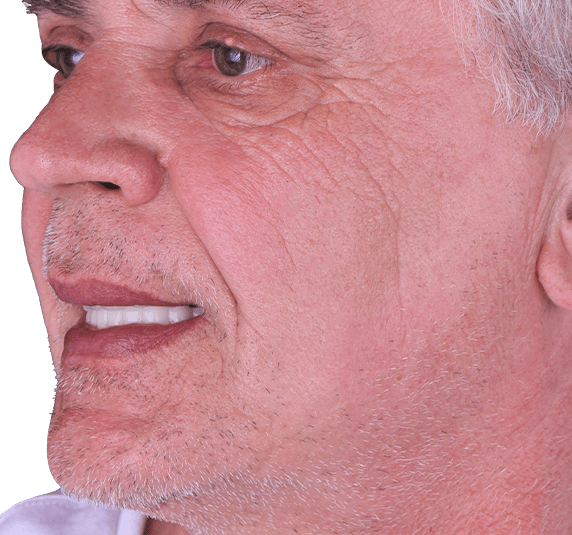 snap on dentures at ocean dental cancun