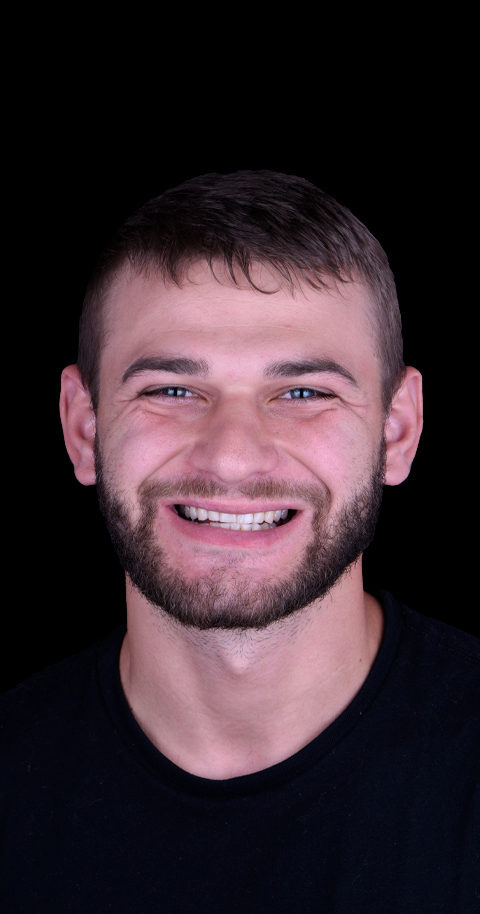 3 on 6 dental implants in mexico full mouth restoration