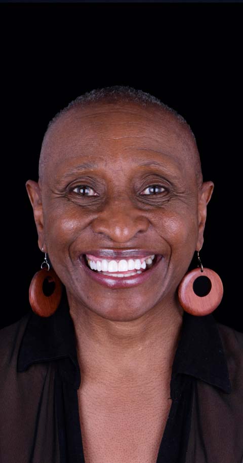 4 in 1 dental impalnts in mexico