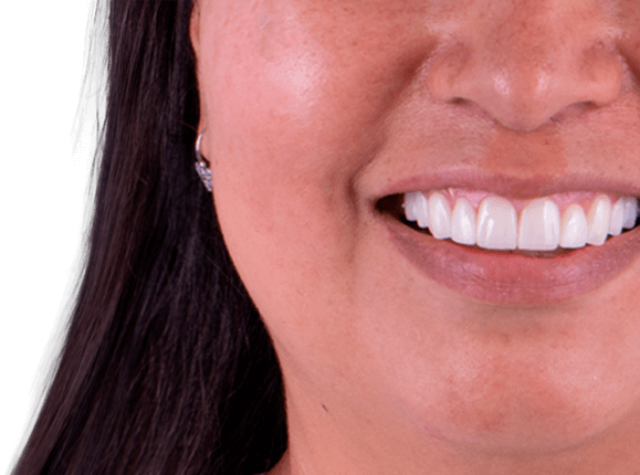 complete dental makeover in cancun mexico