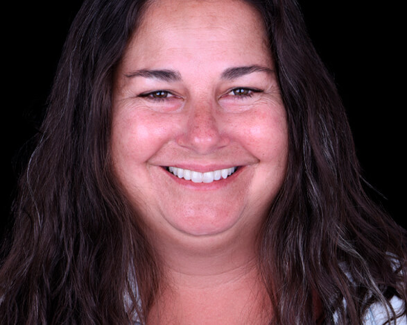 complete smile makeover in cancun