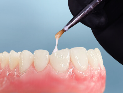 dental bonding in cancun mexico