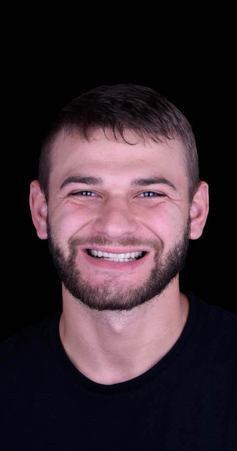 dental braces in mexico before and after