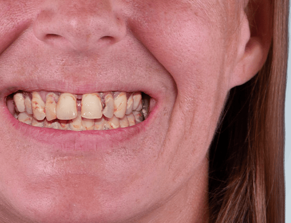 dental implants in mexico complete restoration