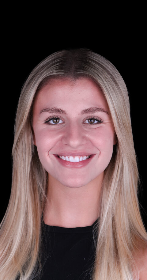 dental veneers before and after in mexico