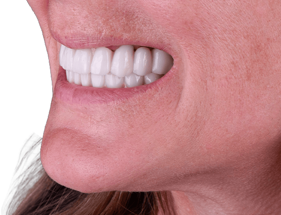 full dental implants in mexico