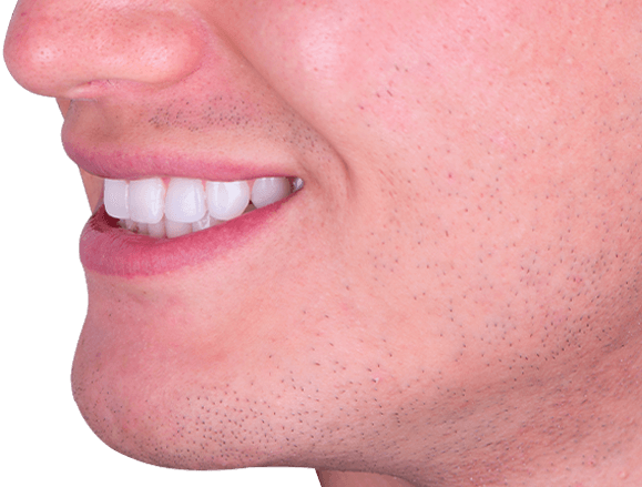 full hollywood smile makeover in mexico