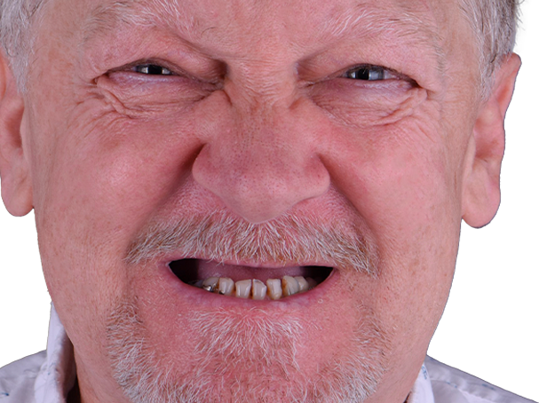 full mouth reconstruction mexico