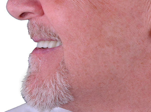 getting full mouth reconstruction in mexico