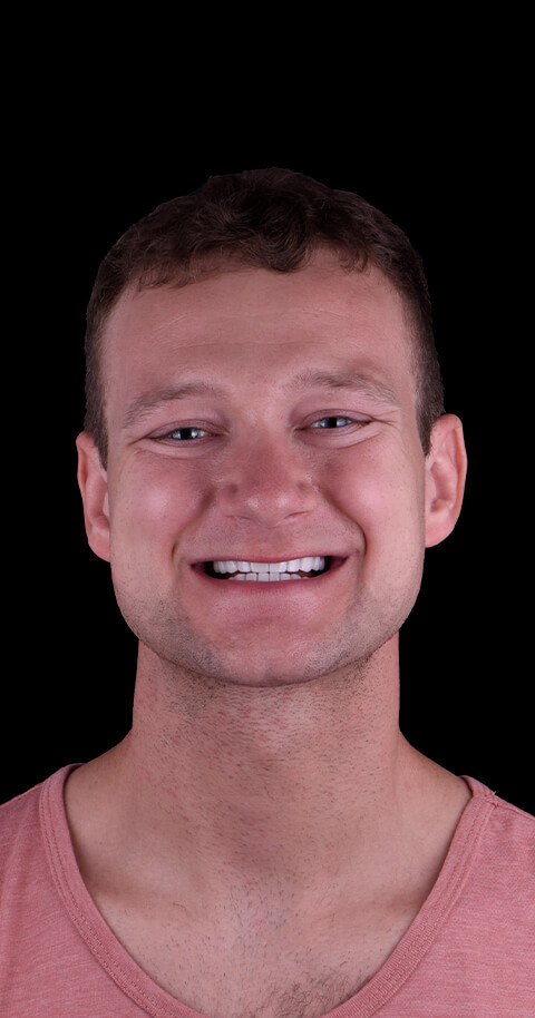 gum graft before and after in mexico