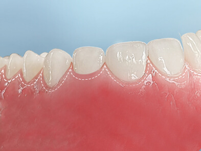 gum surgery in cancun mexico