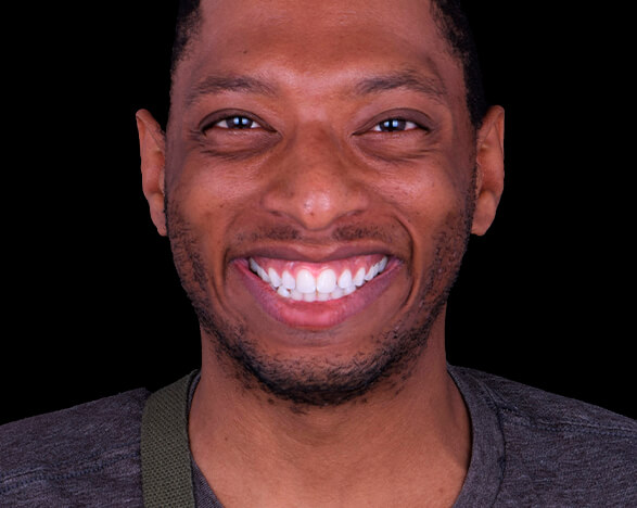 hollywood smile makeover in mexico