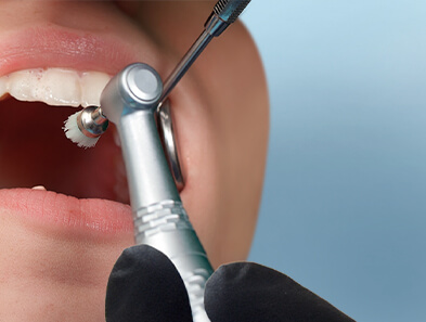 teeth bonding in ocean dental cancun