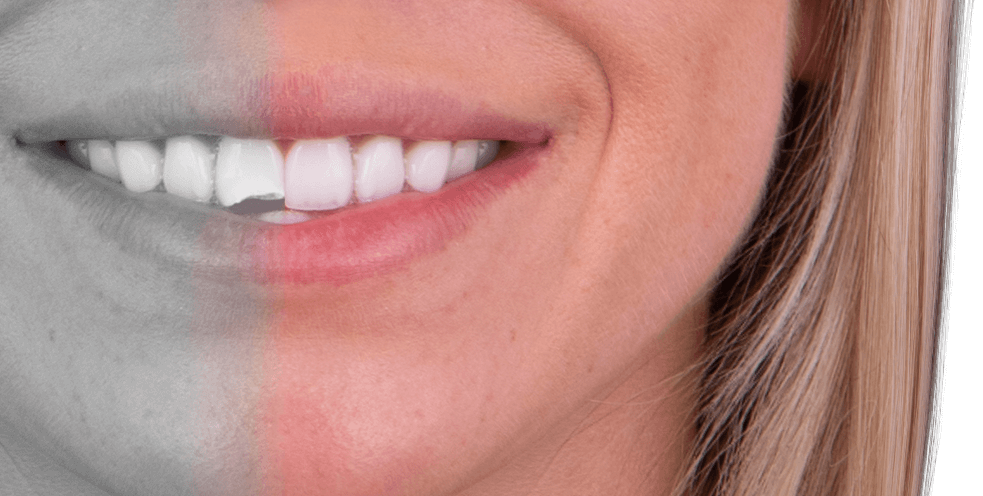 teeth restoration in dental bonding