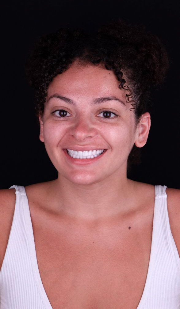 braces in cancun smile makeover