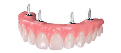 full mouth all on 4 dental implants