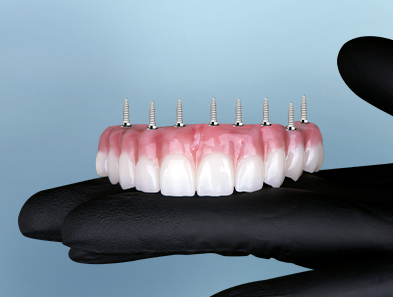 full mouth dental implants in cancun mexico