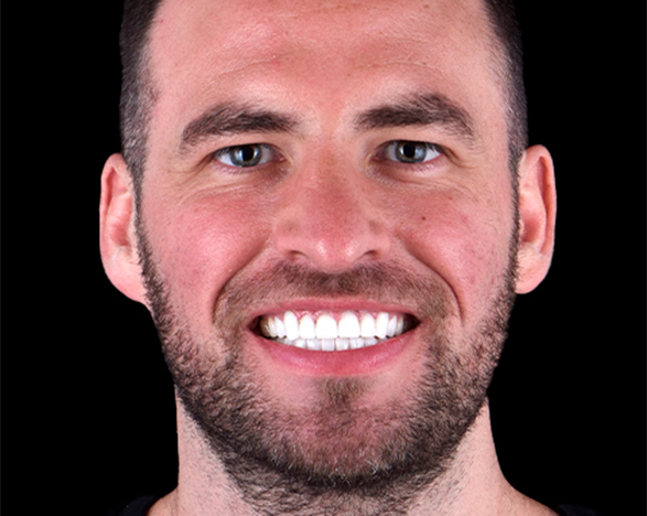 full mouth reconstruction mexico before and after