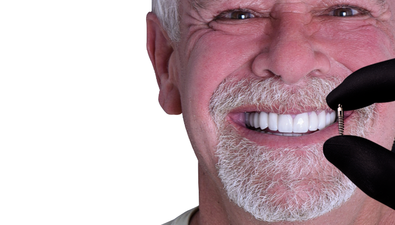 full mouth reconstruction with dental implants in cancun
