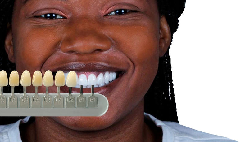 full smile makeover with dental veneers in cancun