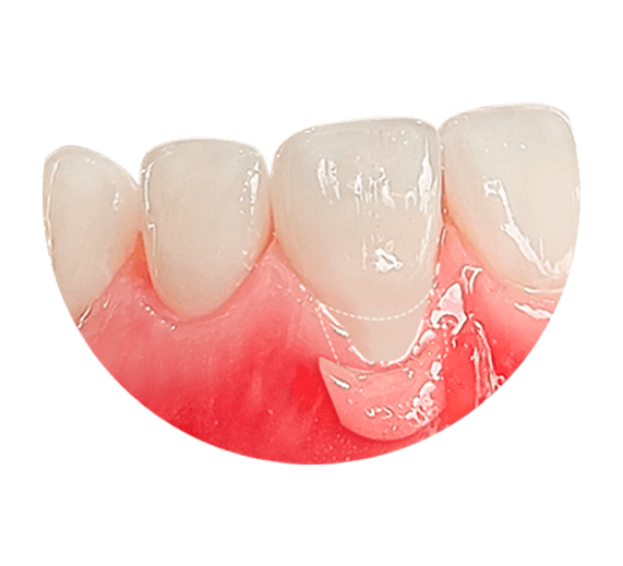 gum contouring in mexico