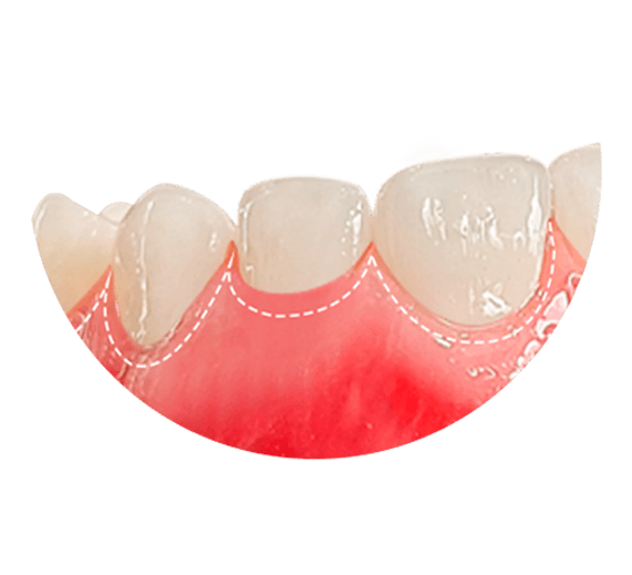 gum reshaping in ocean dental cancun