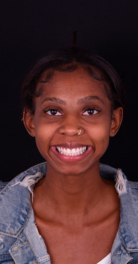 veneers smile makeover in cancun