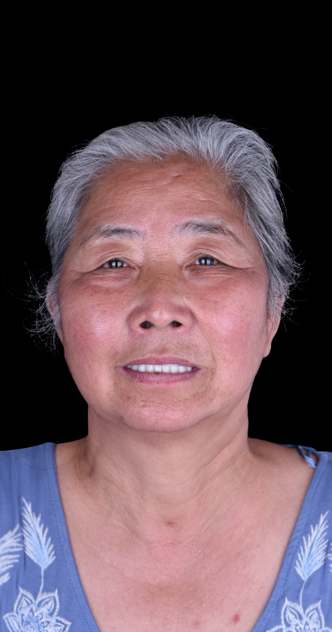 implant retained dentures in cancun